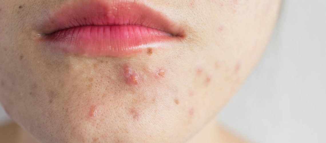 Papules : faut-il les percer, les ignorer ou les traiter ? Papules : faut-il les percer, les ignorer ou les traiter ?